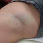 laser-hair-removal-treatment-11
