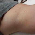 laser-hair-removal-treatment-13