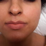 laser-hair-removal-treatment-14