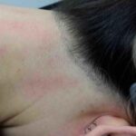 laser-hair-removal-treatment-15