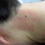 laser-hair-removal-treatment-16