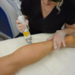 laser-hair-removal-treatment-2