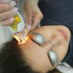 laser-hair-removal-treatment-8