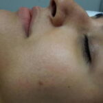laser-hair-removal-treatment-9